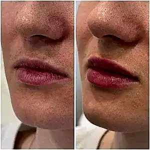 Увеличение губ 20