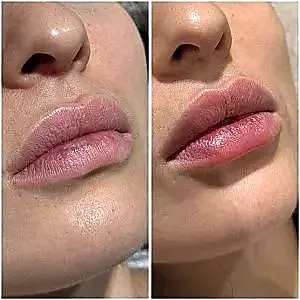 Контурная пластика губ 28