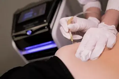 Инъекционная карбокситерапия