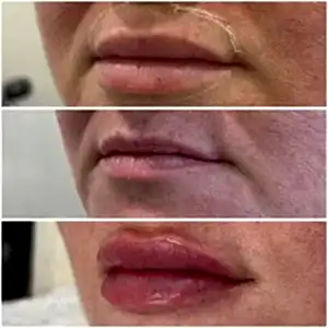 Контурная пластика губ 28+лонгидаза