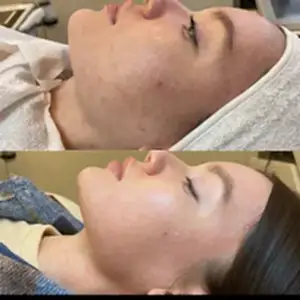 Желтый пилинг