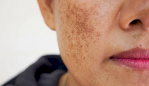 Лазерное удаление пигментных образований